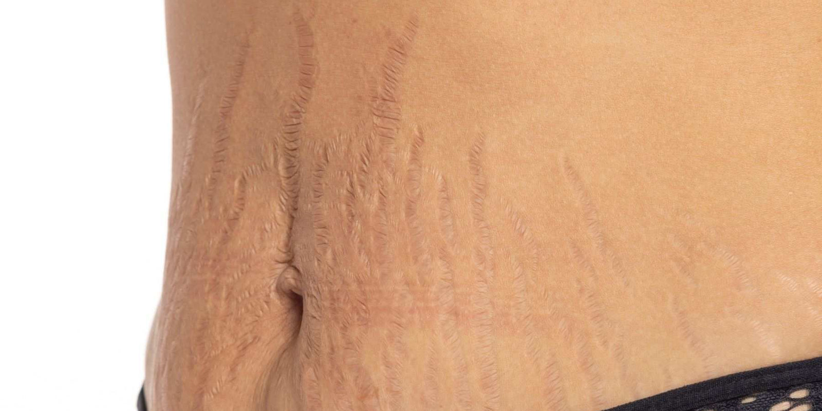 Does Body Butter Really Help With Stretch Marks?