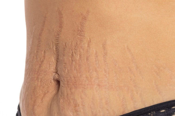 Does Body Butter Really Help With Stretch Marks?