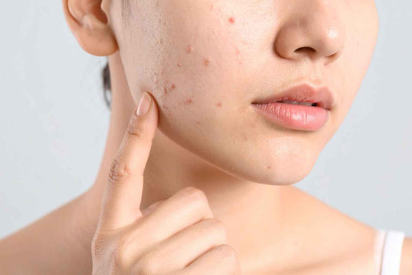 Does Moisturizer Help with Acne