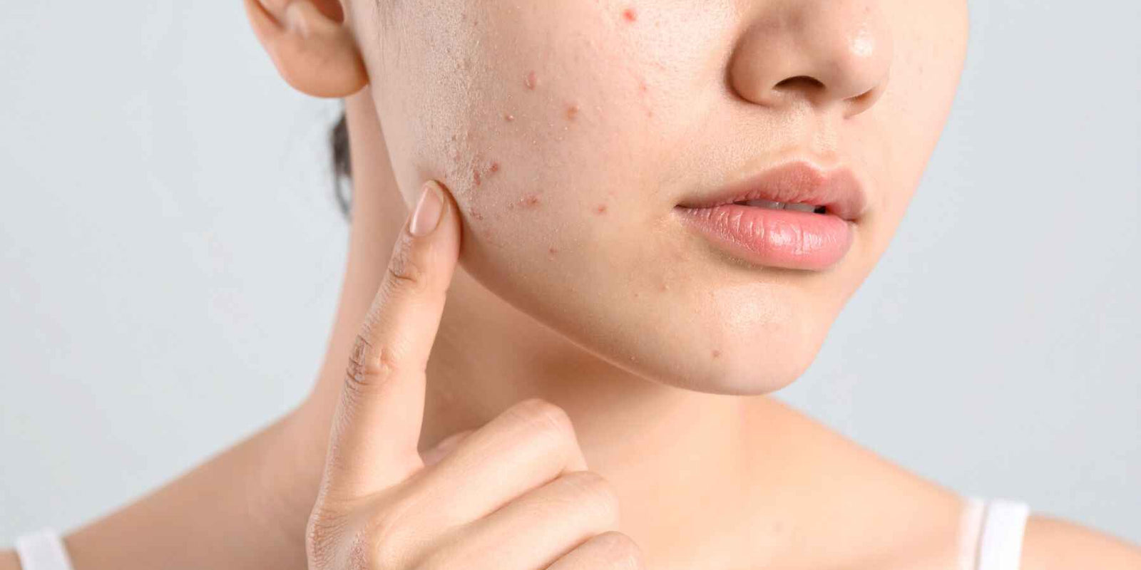 Does Moisturizer Help with Acne