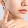 Does Moisturizer Help with Acne